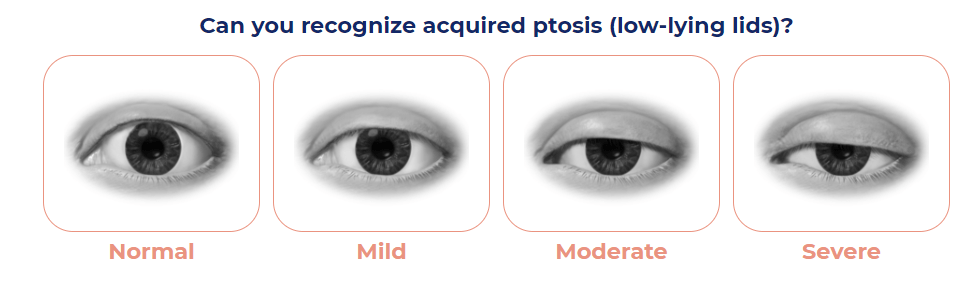 Upneeq for Ptosis